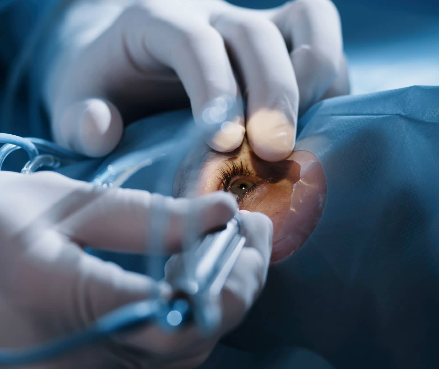 Séance de chirurgie laser Femto-Lasik chez le Dr Hamelin-Gervais au Mans