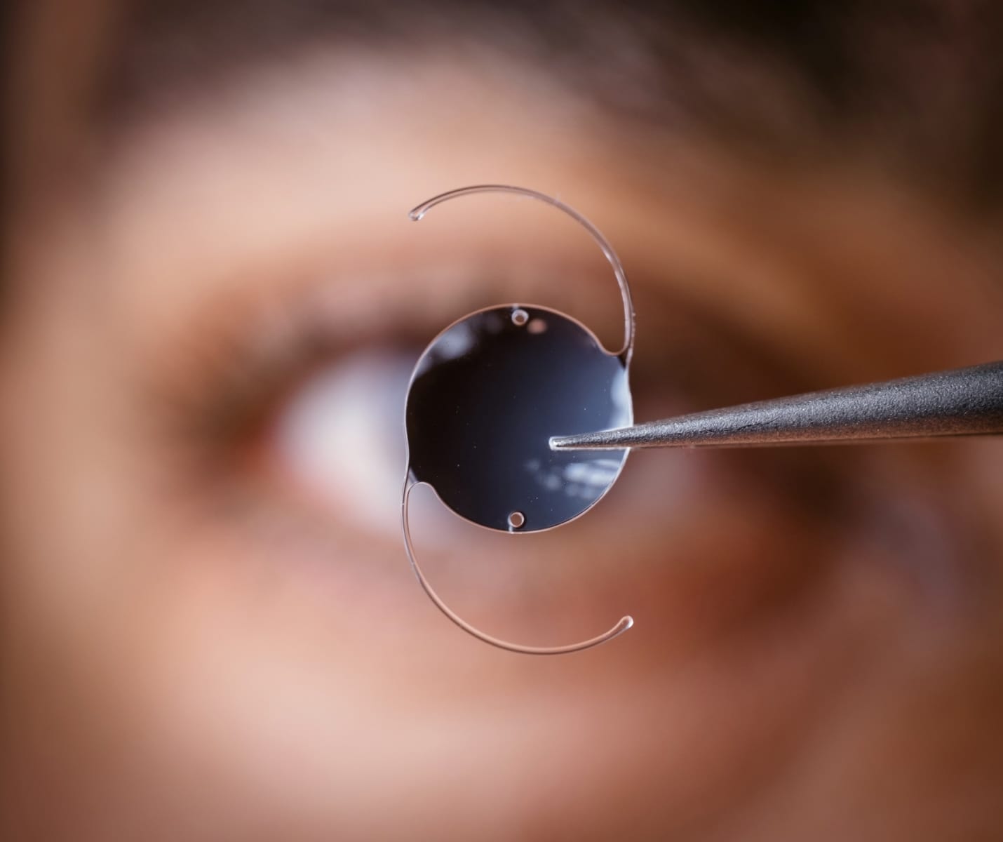 Chirurgie des implants de cataracte chez le Dr Hamelin-Gervais au Mans