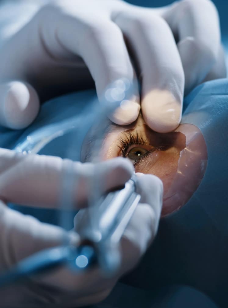 Intervention par laser Femto-Lasik chez le Dr Hamelin-Gervais au Mans