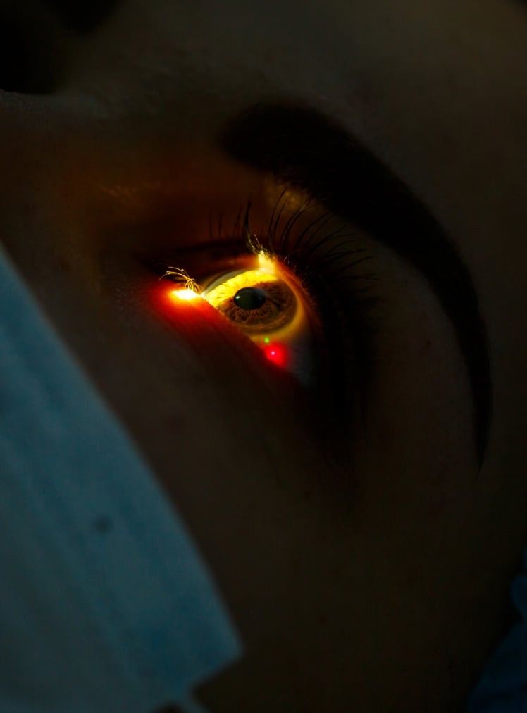 Technique de chirurgie laser PKR chez le Dr Hamelin-Gervais au Mans